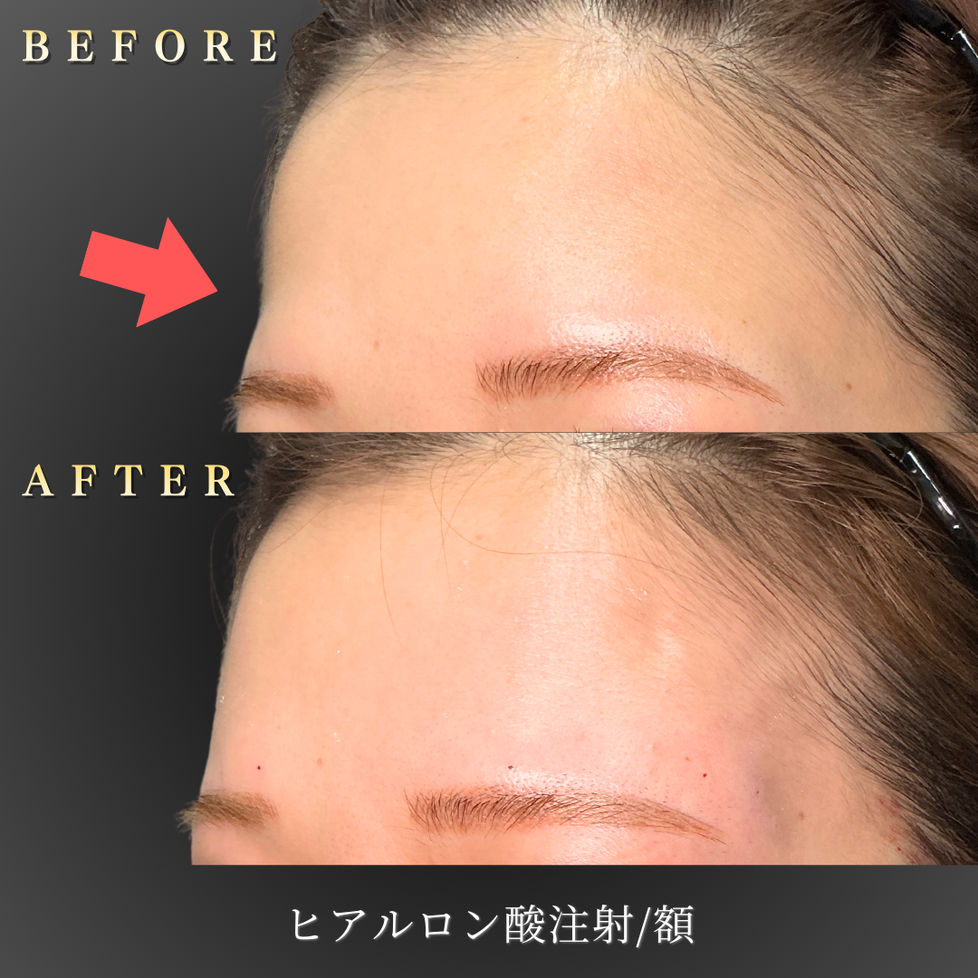 20代女性 額ヒアルロン酸施術のBefore/After斜め写真