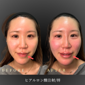 20代 唇ヒアルロン酸 症例写真〔正面Before/After〕｜大阪 心斎橋BiBiクリニック