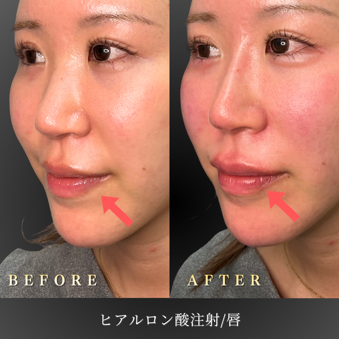 ãªãããã¢ã«ã­ã³é¸æ½è¡å¾ã®èªç¶ãªä»ä¸ãã