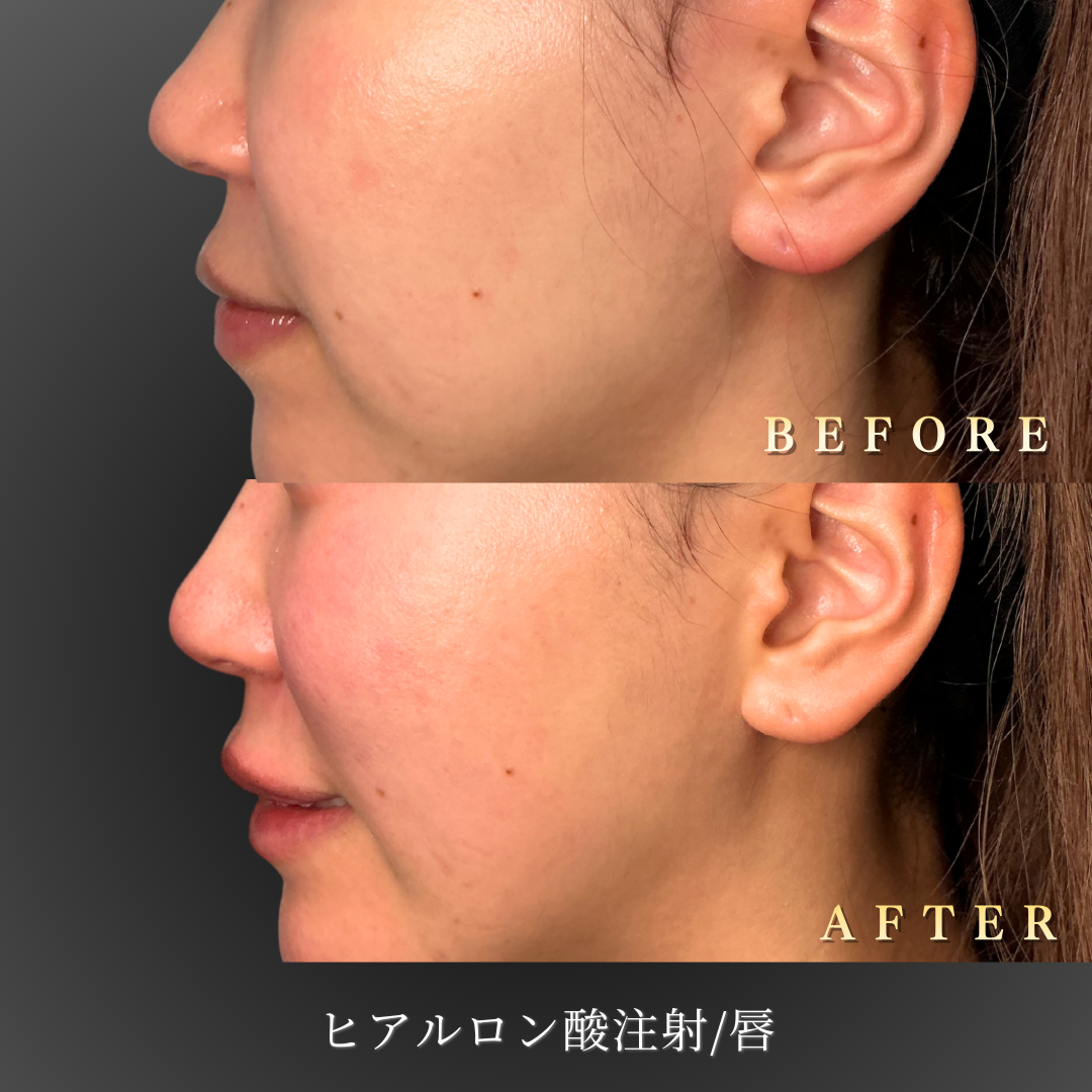 20ä»£å¥³æ§ã®ãªãããã¢ã«ã­ã³é¸ã«ã¦ã³ã»ãªã³ã°é¢¨æ¯