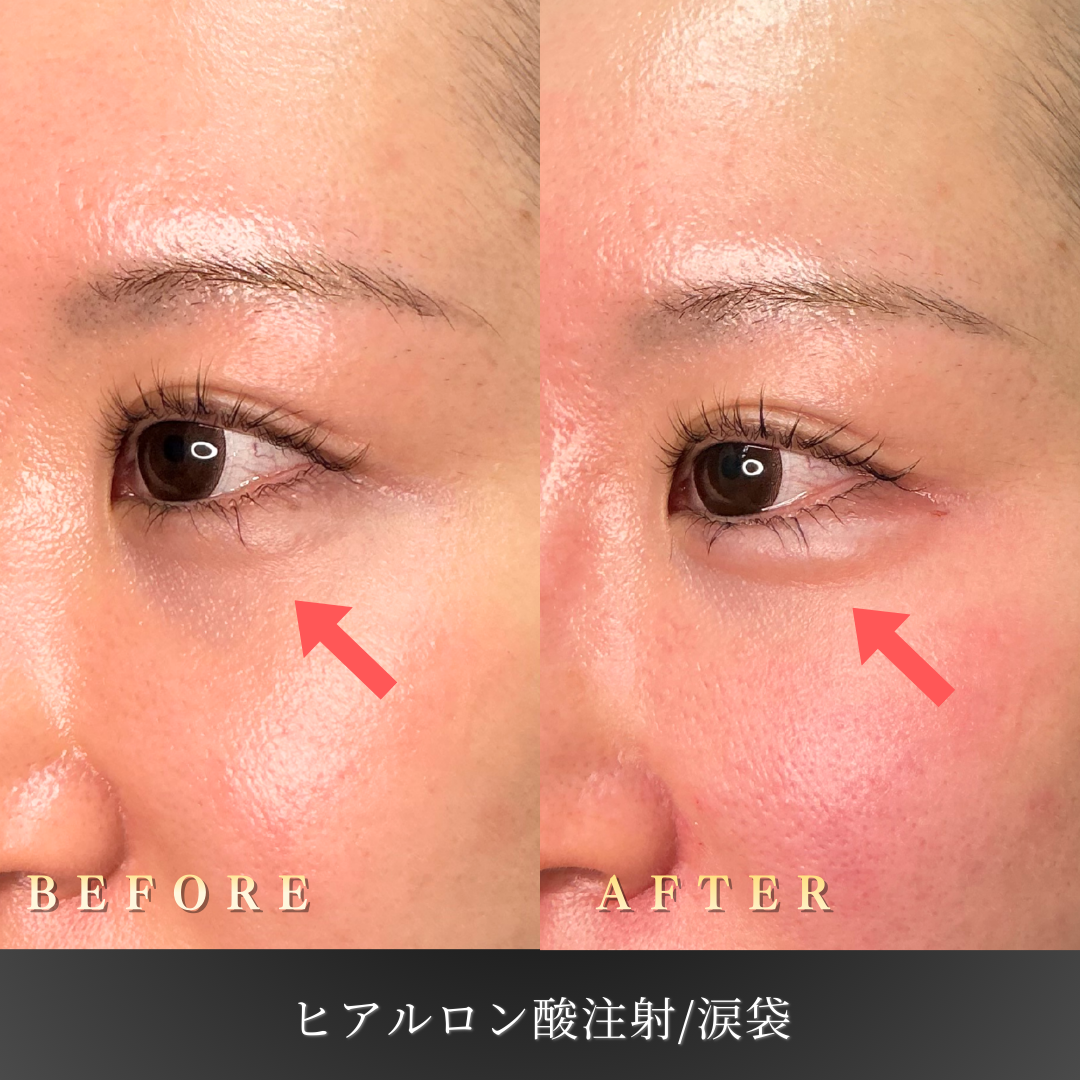 【20代女性】可愛らしい印象を作る涙袋ヒアルロン酸症例｜大阪 心斎橋BiBiクリニックの症例写真