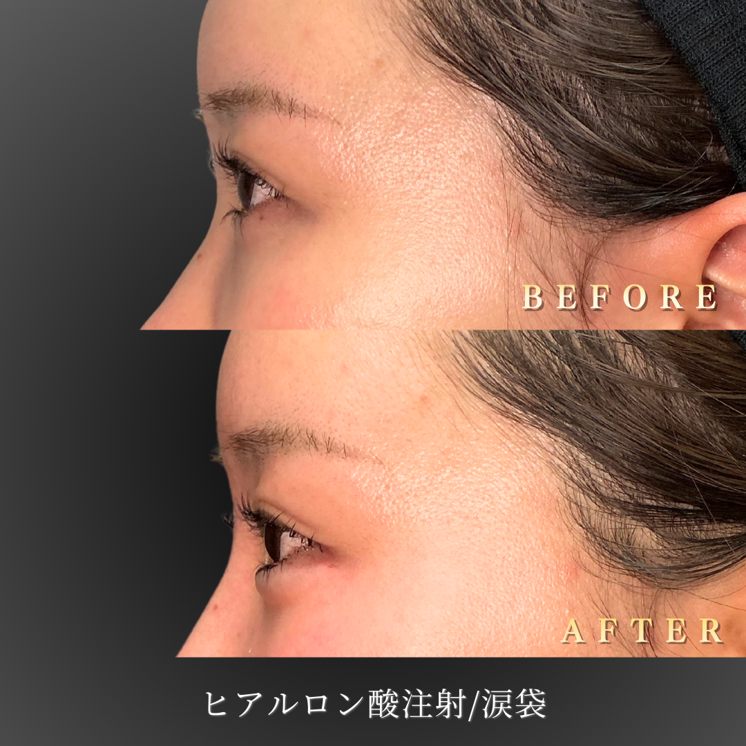 涙袋ヒアルロン酸注入後の目元アップ写真