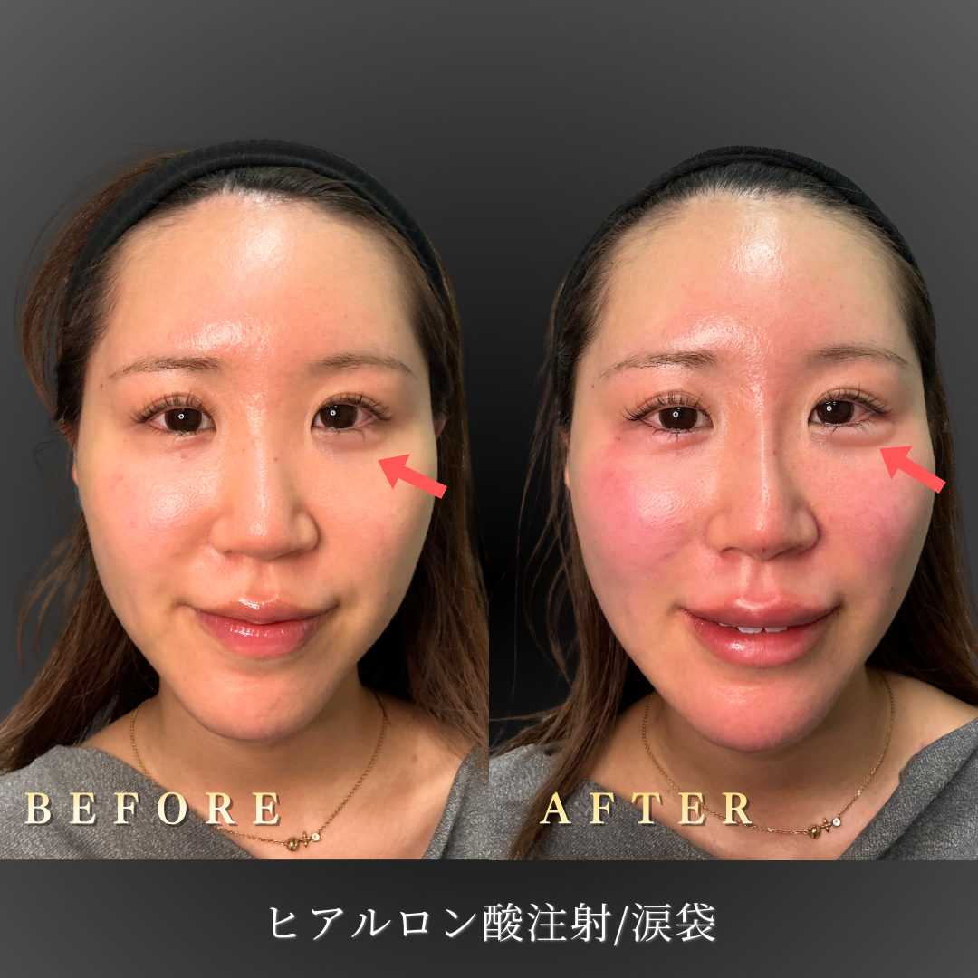 涙袋ヒアルロン酸施術前の目元の状態