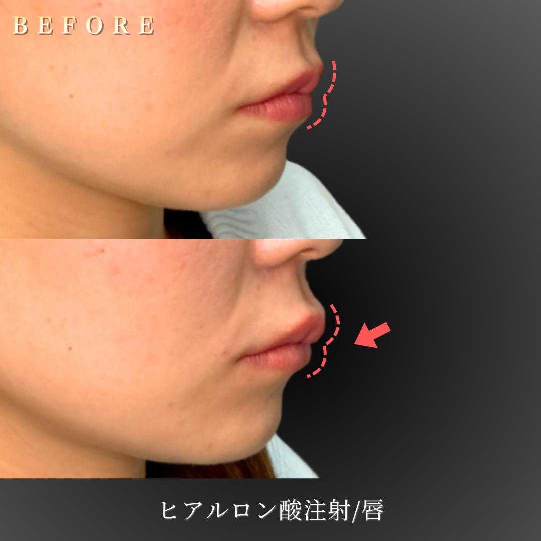 【20代女性】自然なボリュームを出すリップヒアルロン酸症例｜大阪 心斎橋BiBiクリニックの症例写真