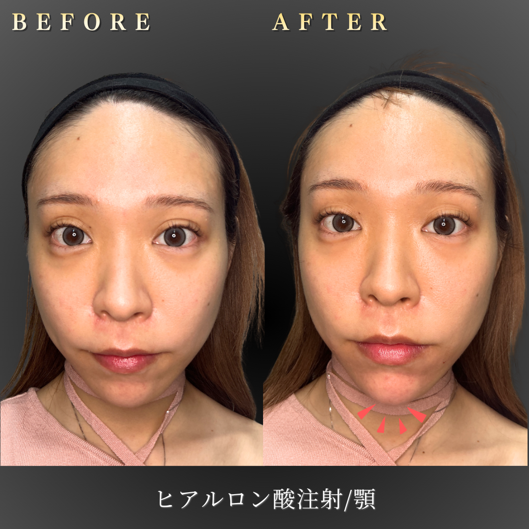 20代女性の顎ヒアルロン酸施術前の正面写真