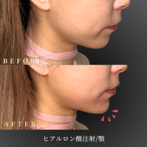 20代 顎ヒアルロン酸 症例写真〔右横Before/After〕｜大阪 心斎橋BiBiクリニック
