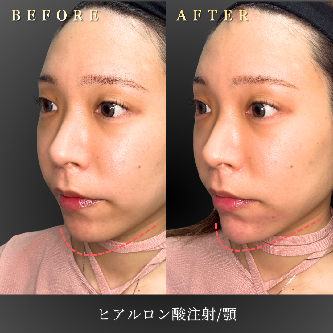 20代女性の顎ヒアルロン酸施術の横顔比較写真