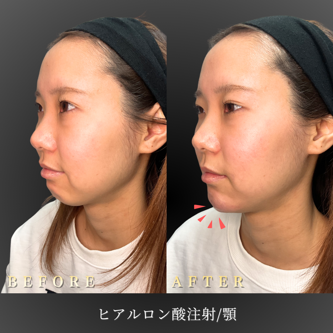 【20代女性】フェイスラインを整える顎ヒアルロン酸症例｜大阪 心斎橋BiBiクリニックの症例写真