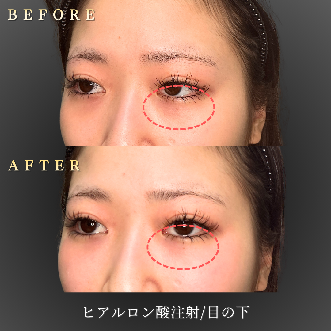 10代女性 中顔面ヒアルロン酸注入前の症例写真