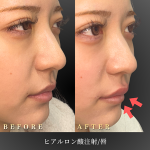 20代 唇ヒアルロン酸 症例写真〔右45度Before/After〕｜大阪 心斎橋BiBiクリニック