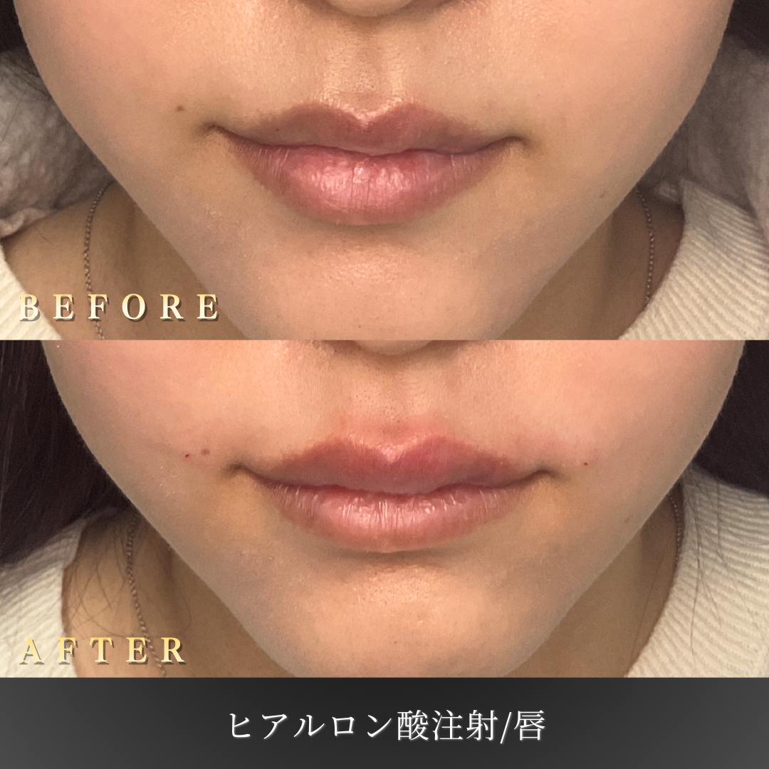 20代女性の施術前の唇の状態