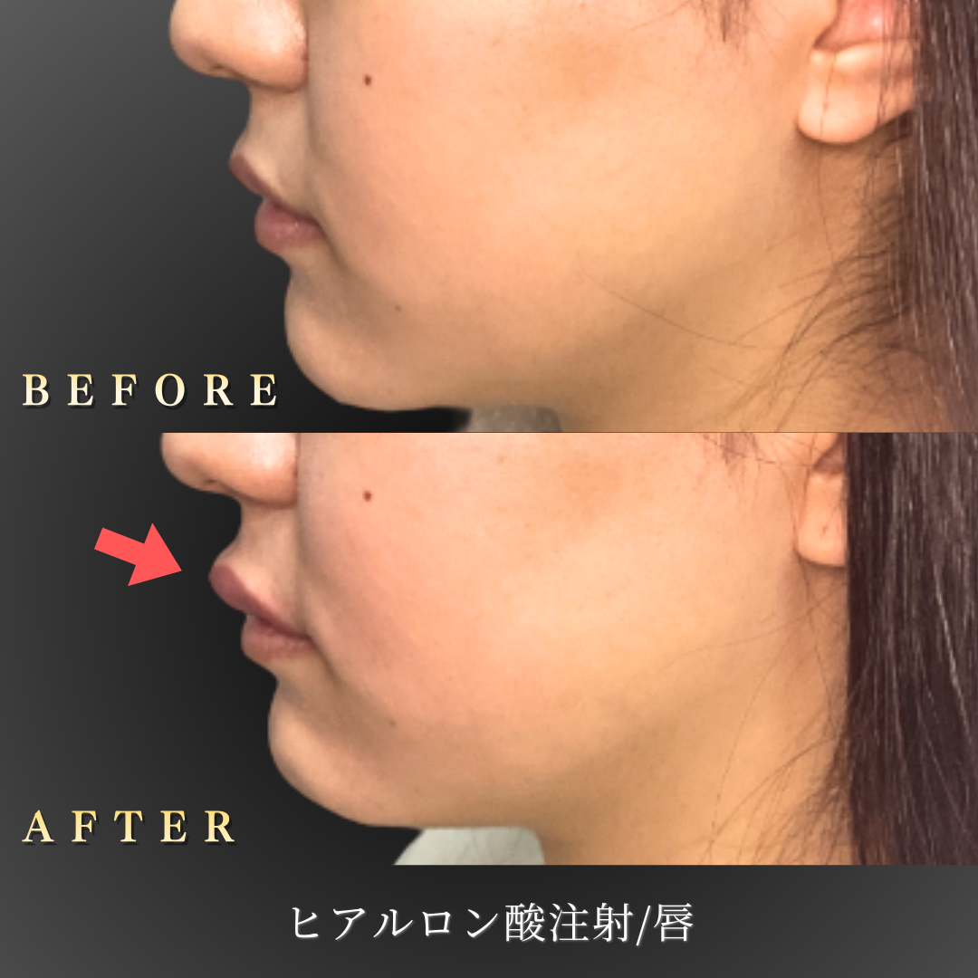 20代女性のリップヒアルロン酸注入後のアップ写真