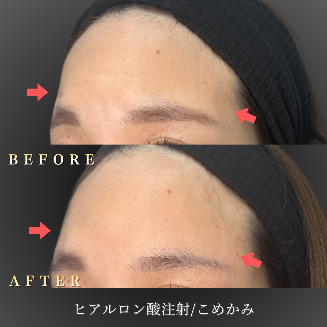 30代女性のこめかみヒアルロン酸施術前後の左斜め45度比較写真｜大阪 心斎橋BiBiクリニック