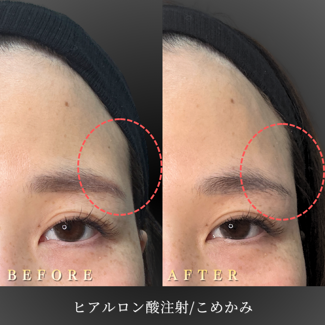 【30代女性】疲れ見えを改善するこめかみヒアルロン酸症例｜大阪 心斎橋BiBiクリニックの症例写真