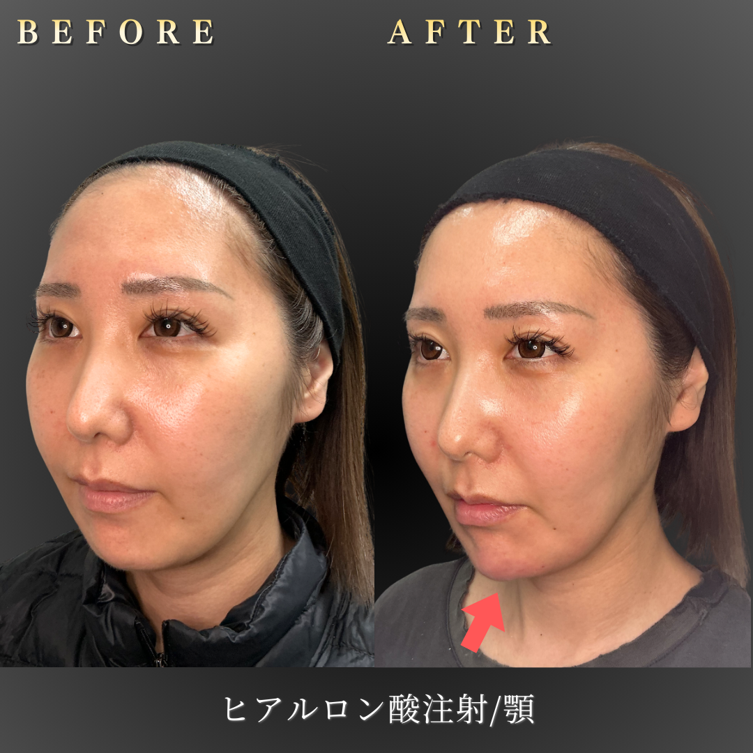 30代女性の顎ヒアルロン酸施術後の斜め45度写真