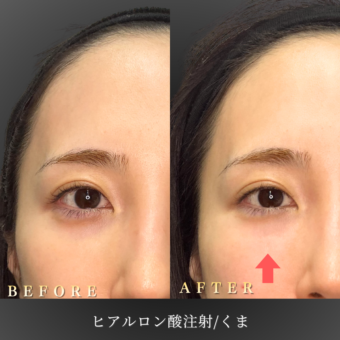 20代女性の目の下のくま ヒアルロン酸注入施術前後のアップ写真