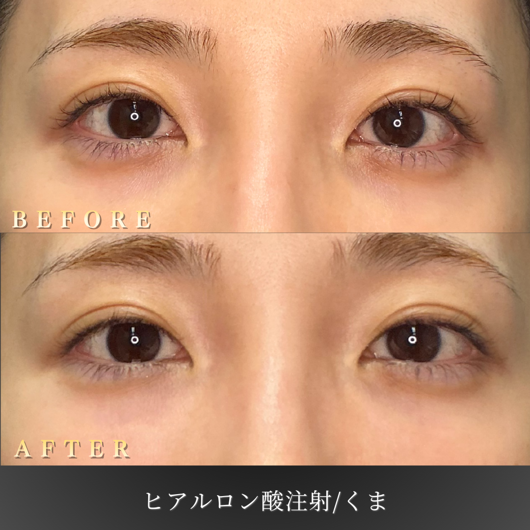 【20代女性】メイクに頼らない中顔面ヒアルロン酸症例｜大阪 心斎橋BiBiクリニックの症例写真