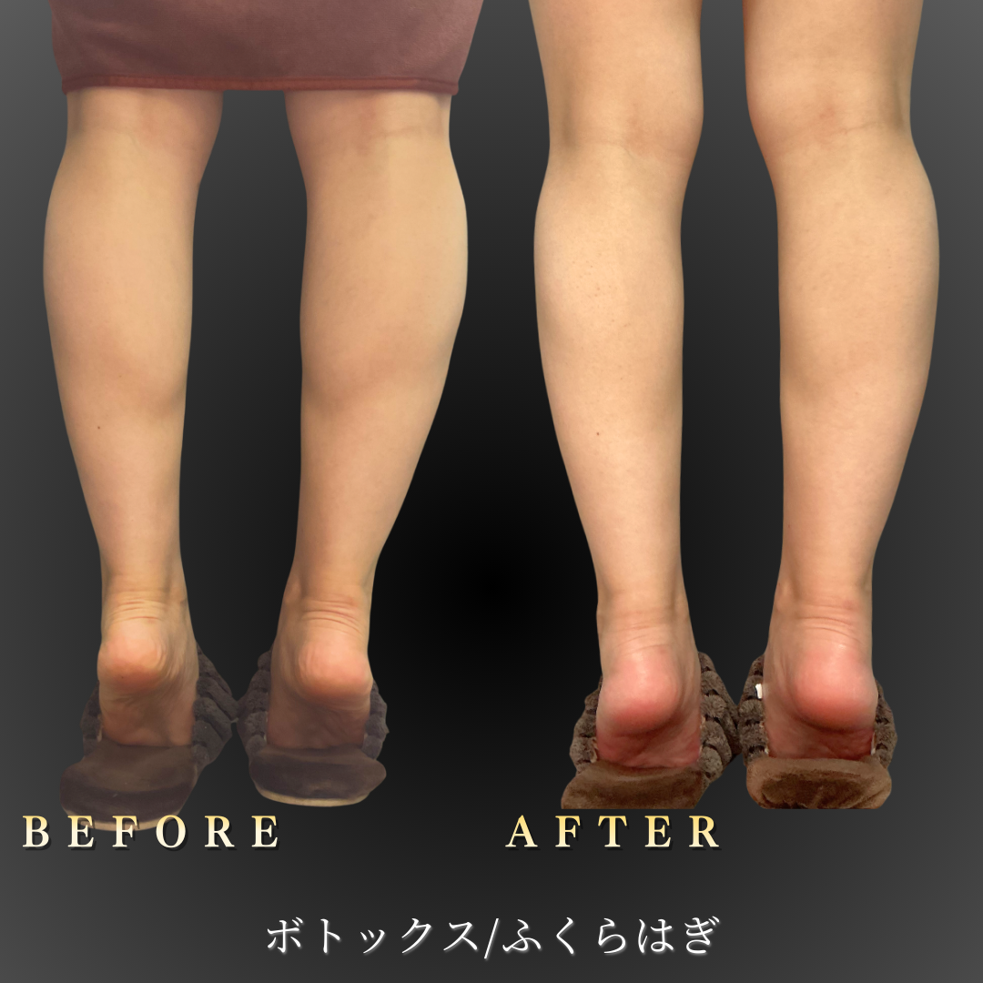 【30代女性】張りが強くなった筋肉を抑えるふくらはぎボトックス症例｜大阪 心斎橋BiBiクリニックの症例写真