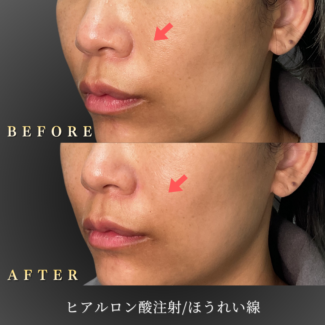 40代女性のほうれい線ヒアルロン酸注入施術前後の左45度写真