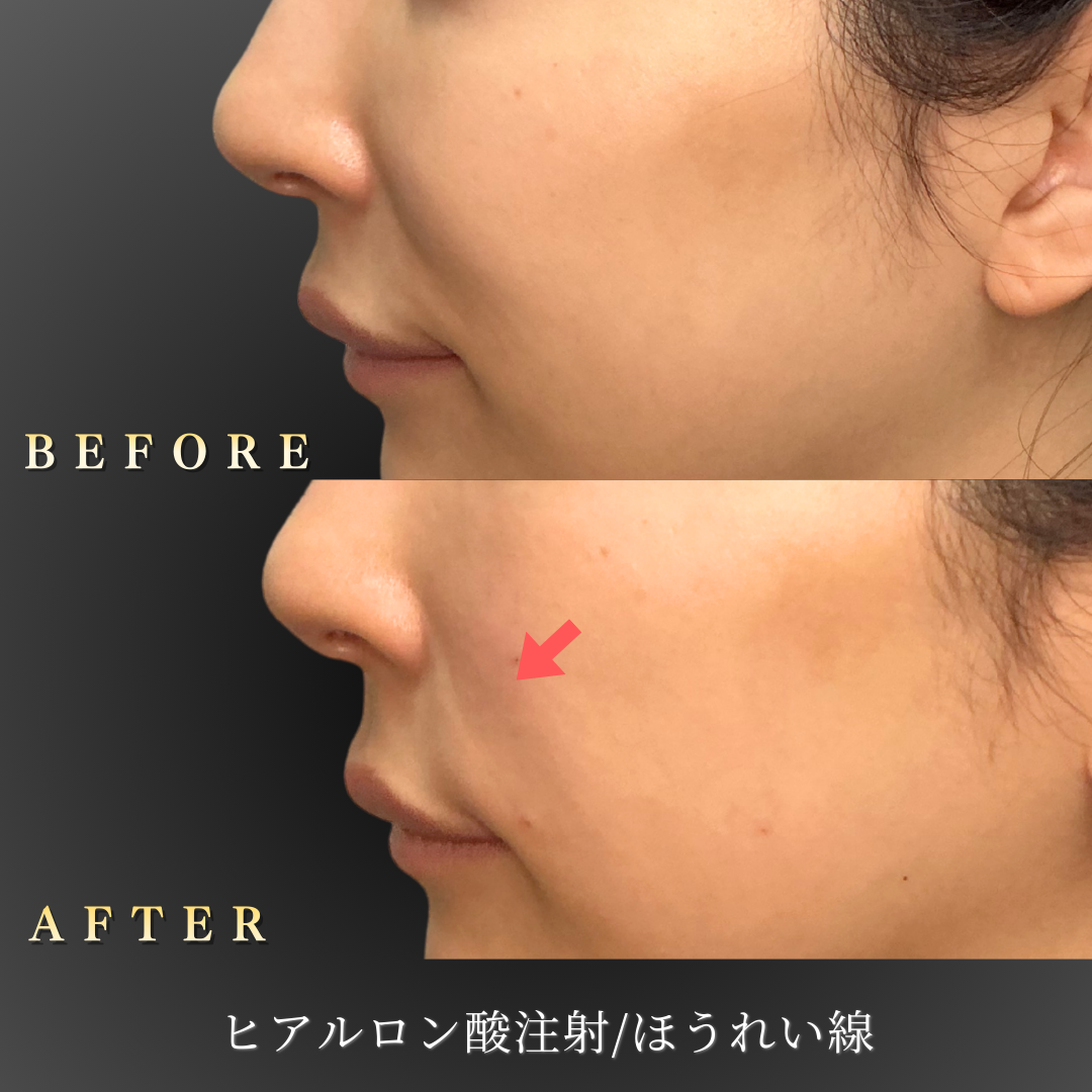 30代女性のほうれい線ヒアルロン酸治療のBefore/After詳細写真｜大阪心斎橋BiBiクリニック