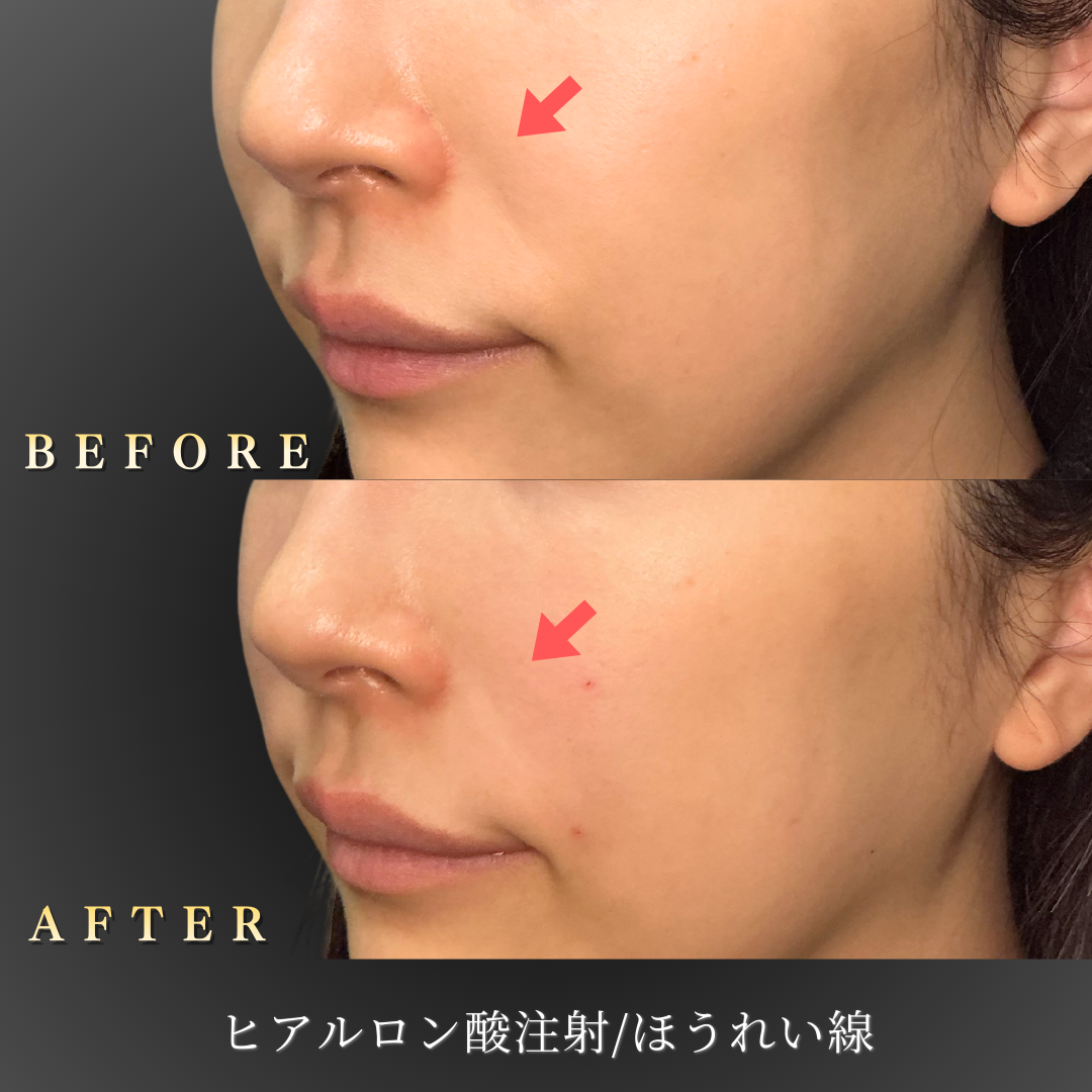 【30代女性】定着し始めた線を整える症例｜大阪 心斎橋BiBiクリニックの症例写真