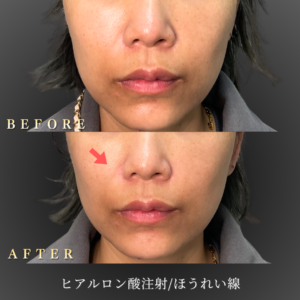 40代ほうれい線ヒアルロン酸 症例写真〔正面Before_After〕｜大阪 心斎橋BiBiクリニック