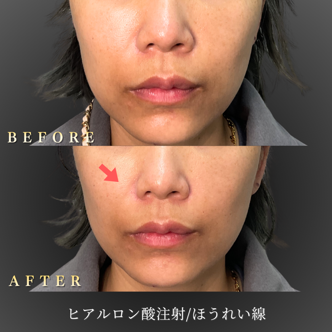 【40代女性】ほうれい線の左右差を自然に整えた症例｜大阪 心斎橋BiBiクリニックの症例写真