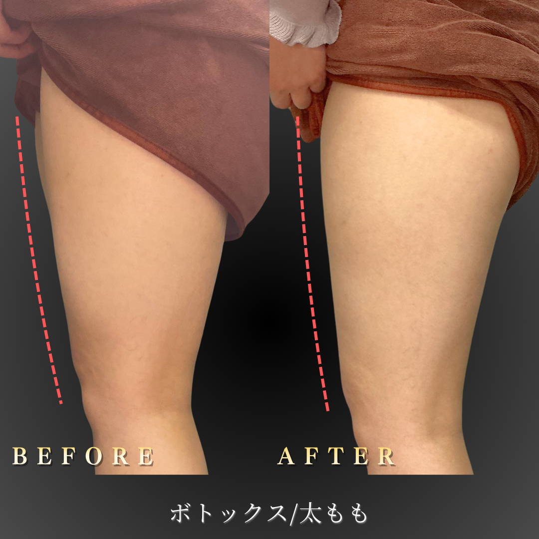 【30代女性】ビエノックスで太ももの筋肉を引き締める下半身ボトックス症例｜大阪 心斎橋BiBiクリニックの症例写真