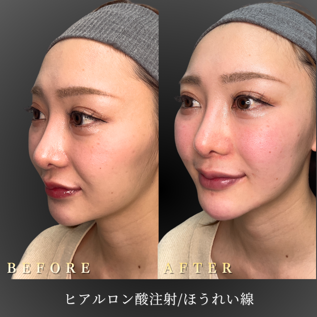 【20代女性】疲れ見えを改善するほうれい線ヒアルロン酸症例｜大阪 心斎橋BiBiクリニックの症例写真