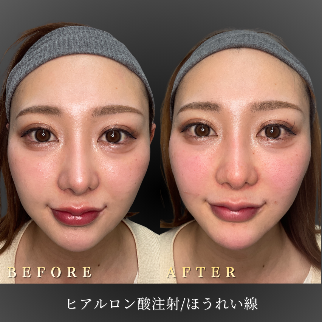 20代女性のほうれい線改善後の表情変化