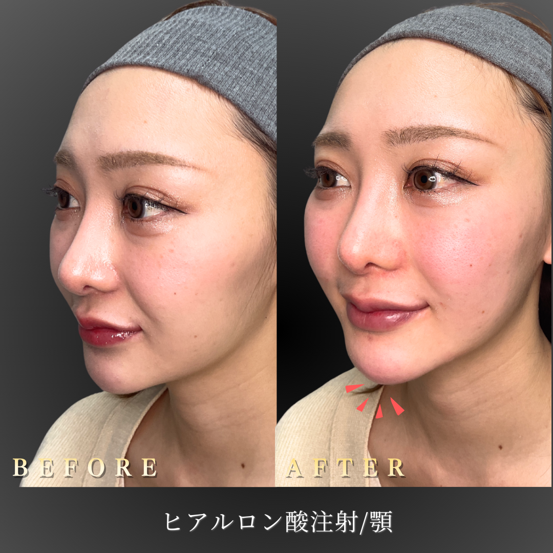 顎ヒアルロン酸注入による女性らしいラインの変化