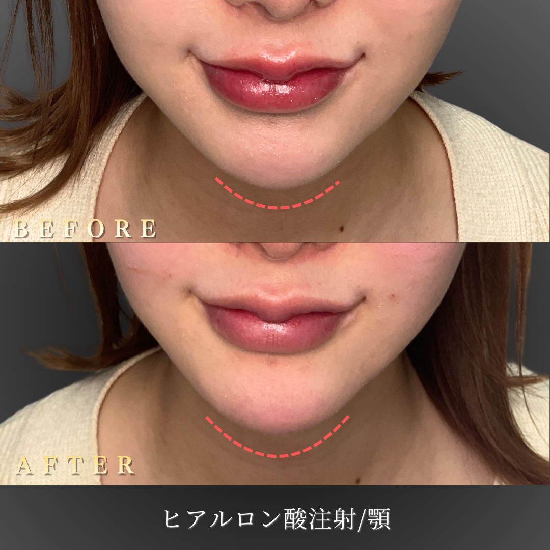 顎ヒアルロン酸治療前の患者様の横顔写真