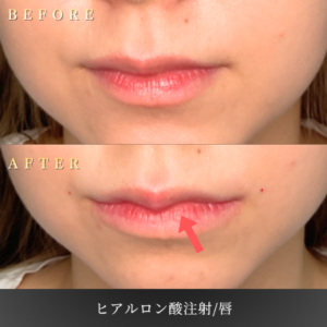20代 唇ヒアルロン酸 症例写真〔正面Before/After〕｜大阪 心斎橋BiBiクリニック