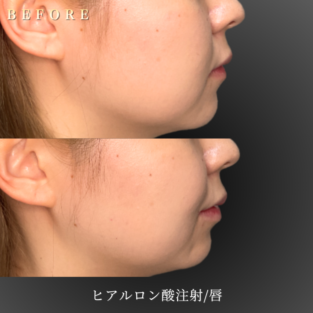 20代女性の唇の側面からの施術前後の変化」 style=