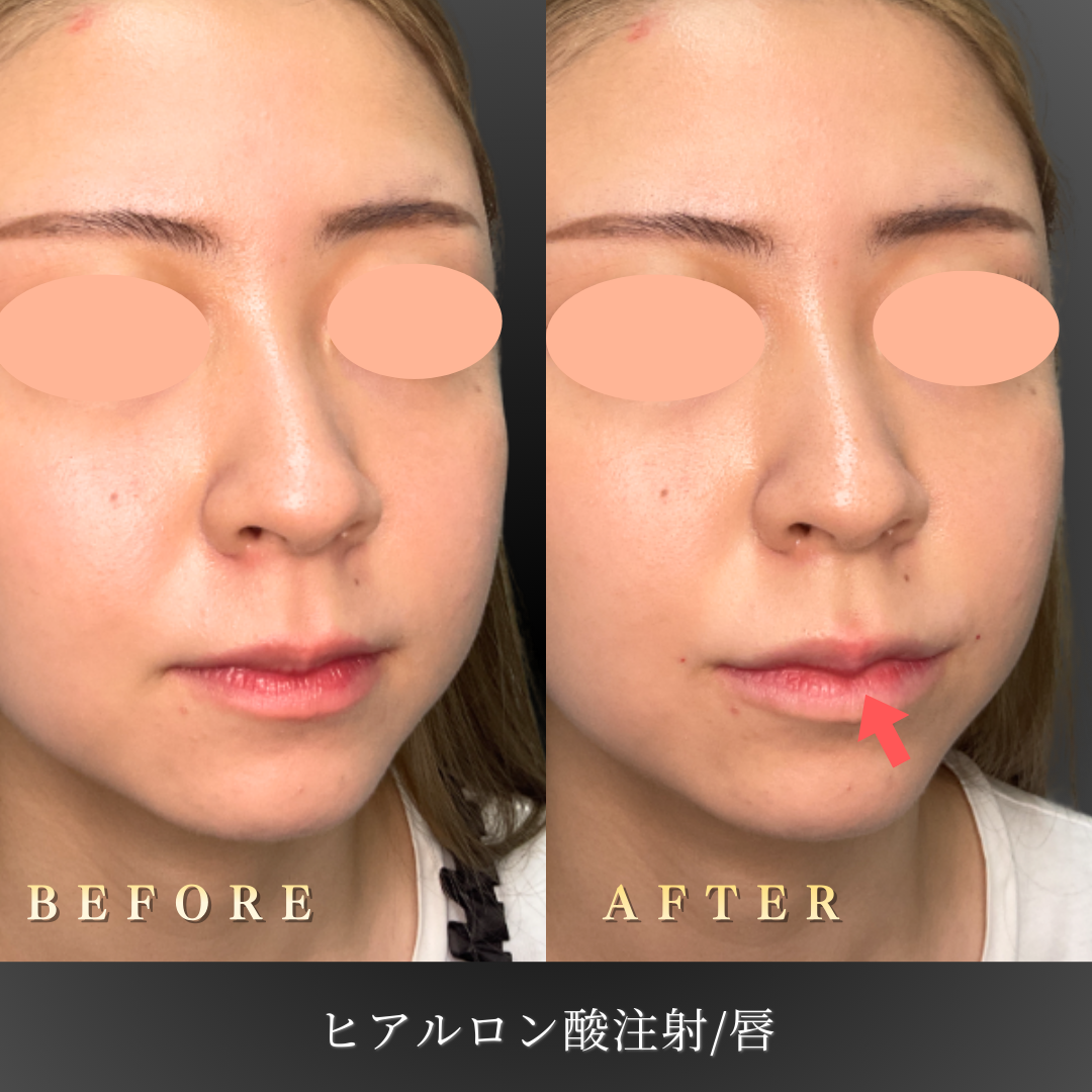 20代女性のリップヒアルロン酸施術前後の唇の形状比較」 style=