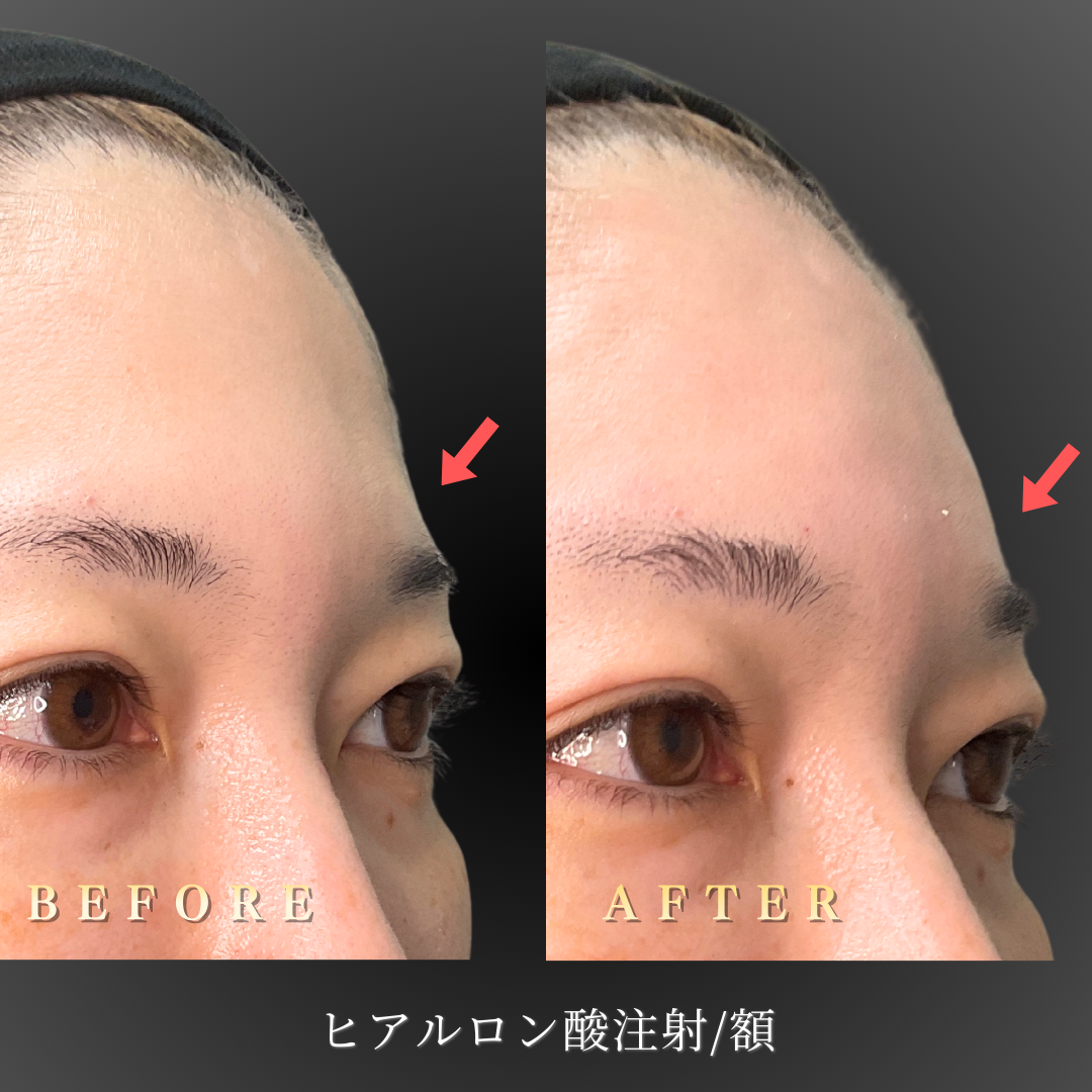 30代女性の額ヒアルロン酸施術前の状態