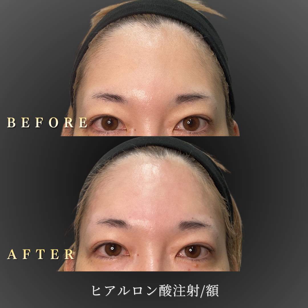 額のハリが低下した30代女性の症例写真