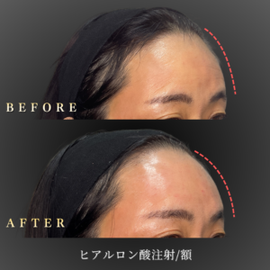 50代 額ヒアルロン酸 症例写真〔右45度Before/After〕｜大阪 心斎橋BiBiクリニック