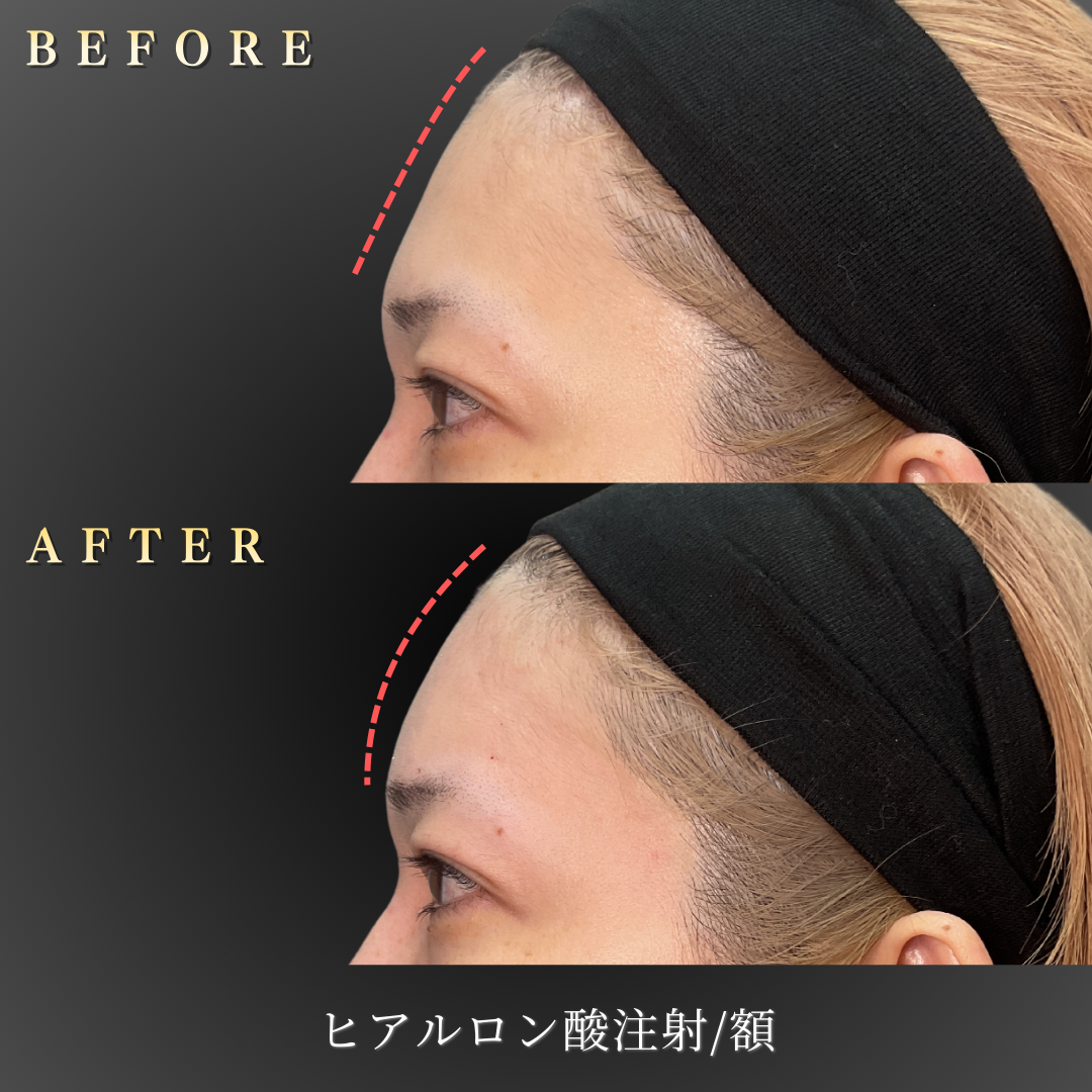 【30代女性】ハリを取り戻す額ヒアルロン酸症例｜大阪 心斎橋BiBiクリニックの症例写真