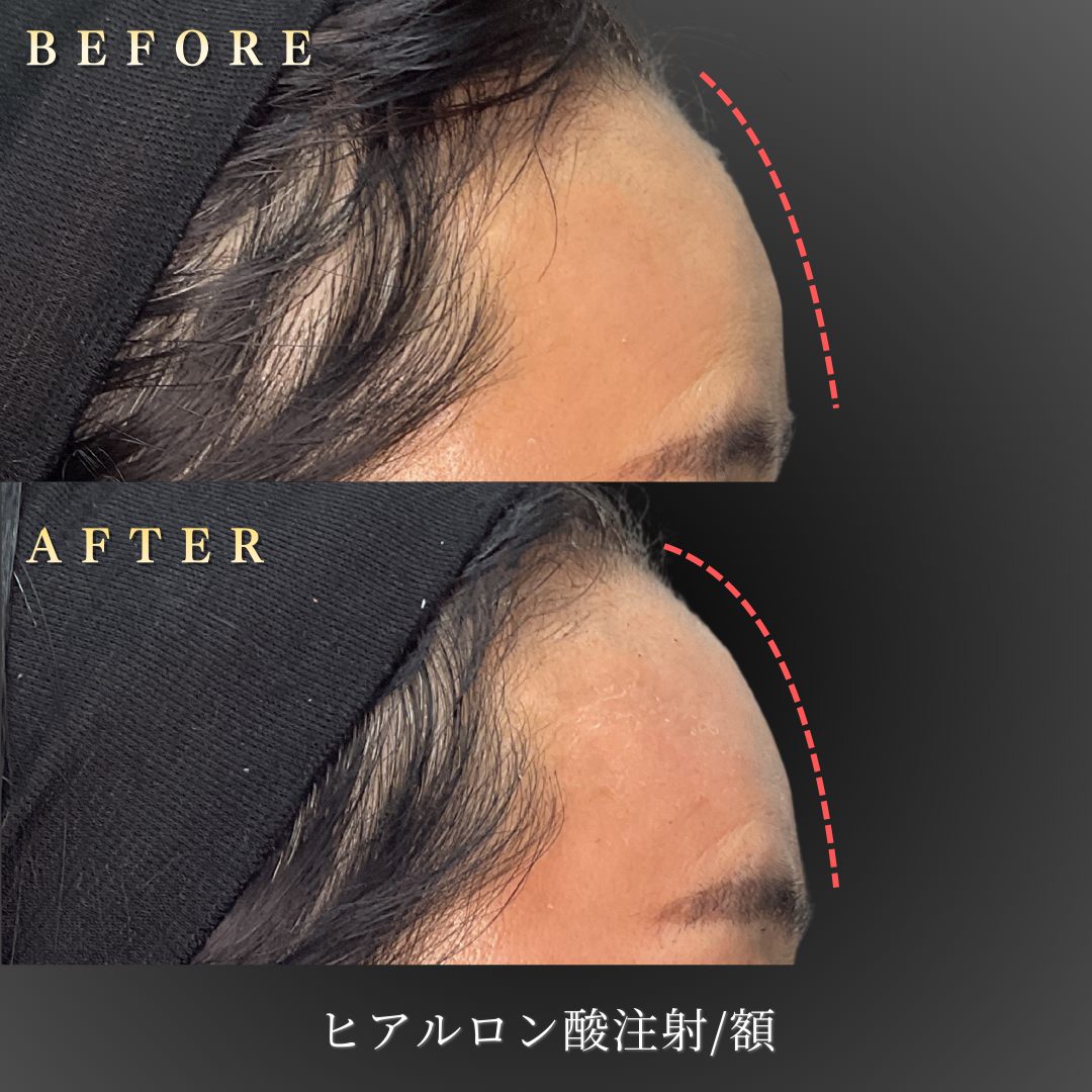 50代女性の額ヒアルロン酸施術による立体感向上の側面写真