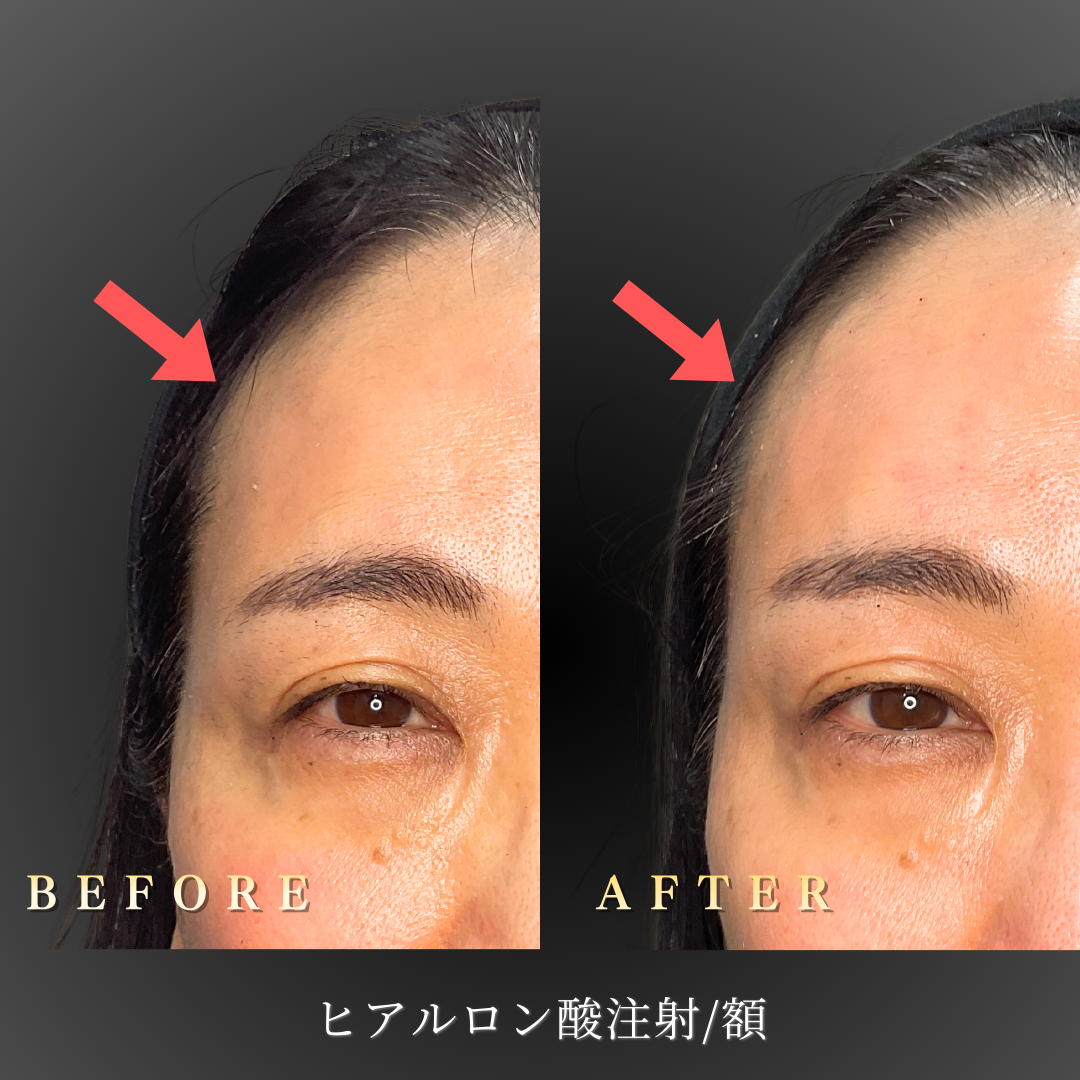 50代女性の額のボリューム低下によるくぼみを示す施術前の写真