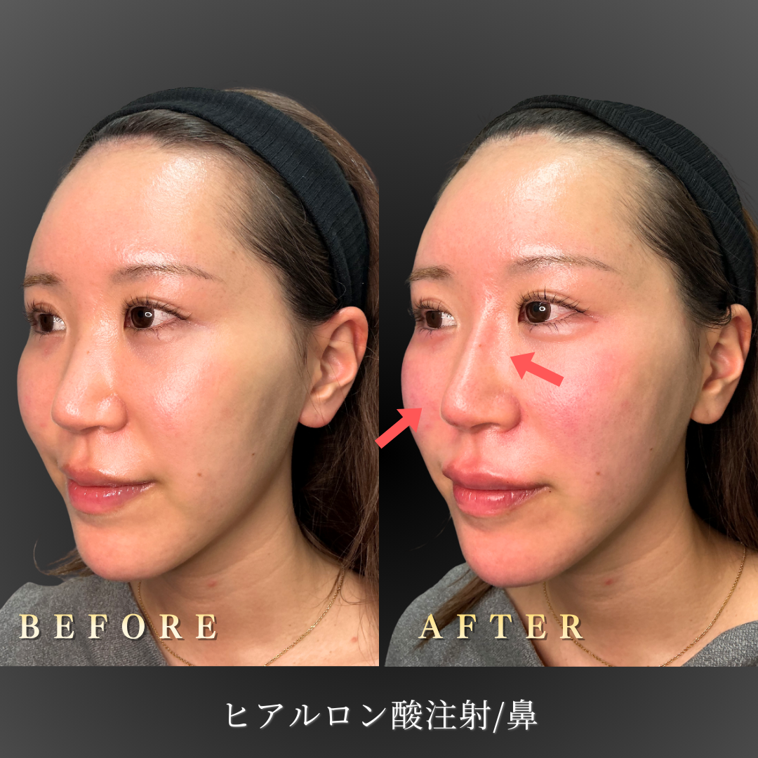 【20代女性】立体感を出す鼻筋ヒアルロン酸症例｜大阪 心斎橋BiBiクリニックの症例写真