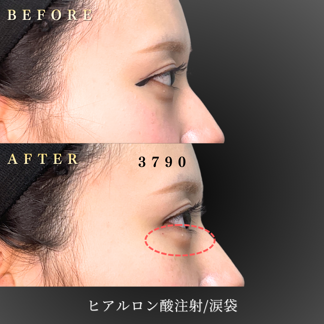 20代女性の涙袋ヒアルロン酸施術後の正面写真