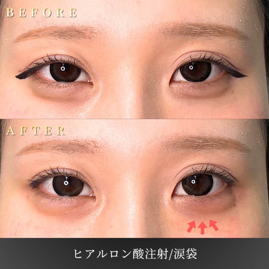 20代女性の涙袋ヒアルロン酸施術前後の比較写真