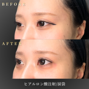 20代 涙袋ヒアルロン酸 症例写真〔左45度Before/After〕｜大阪 心斎橋BiBiクリニック