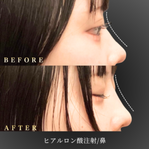 20代 鼻ヒアルロン酸 症例写真〔右横Before/After〕｜大阪 心斎橋BiBiクリニック