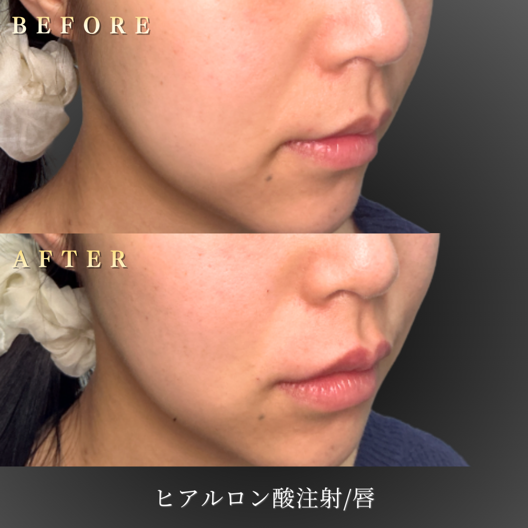 20代女性のリップヒアルロン酸施術After正面写真
