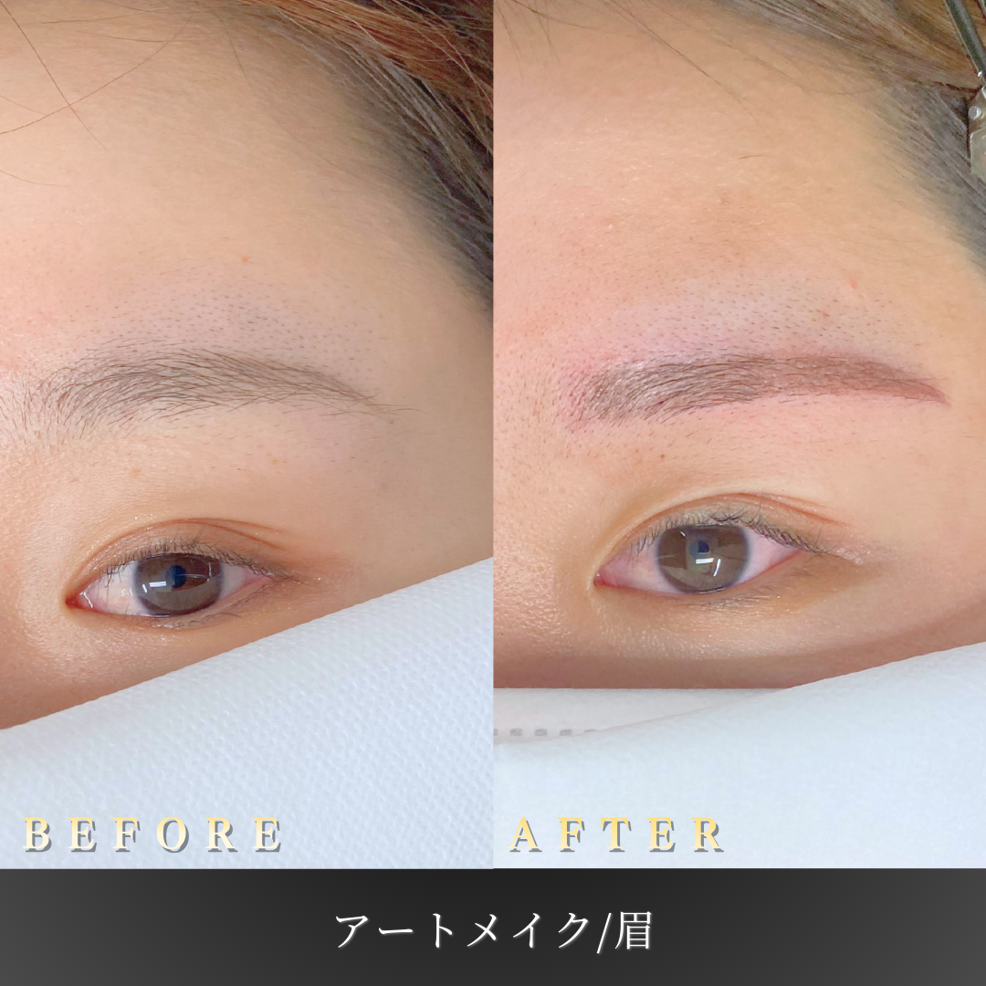 【20代女性】似合う眉を見つける眉アートメイク症例｜大阪 心斎橋BiBiクリニックの症例写真