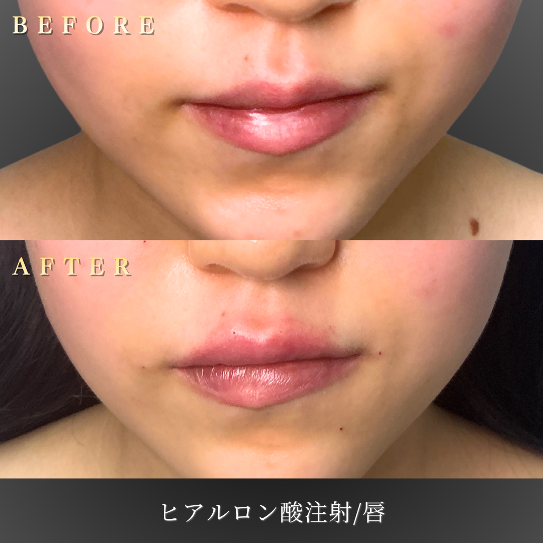 ナチュラルメイクでも存在感のあるリップヒアルロン酸注入後の正面写真