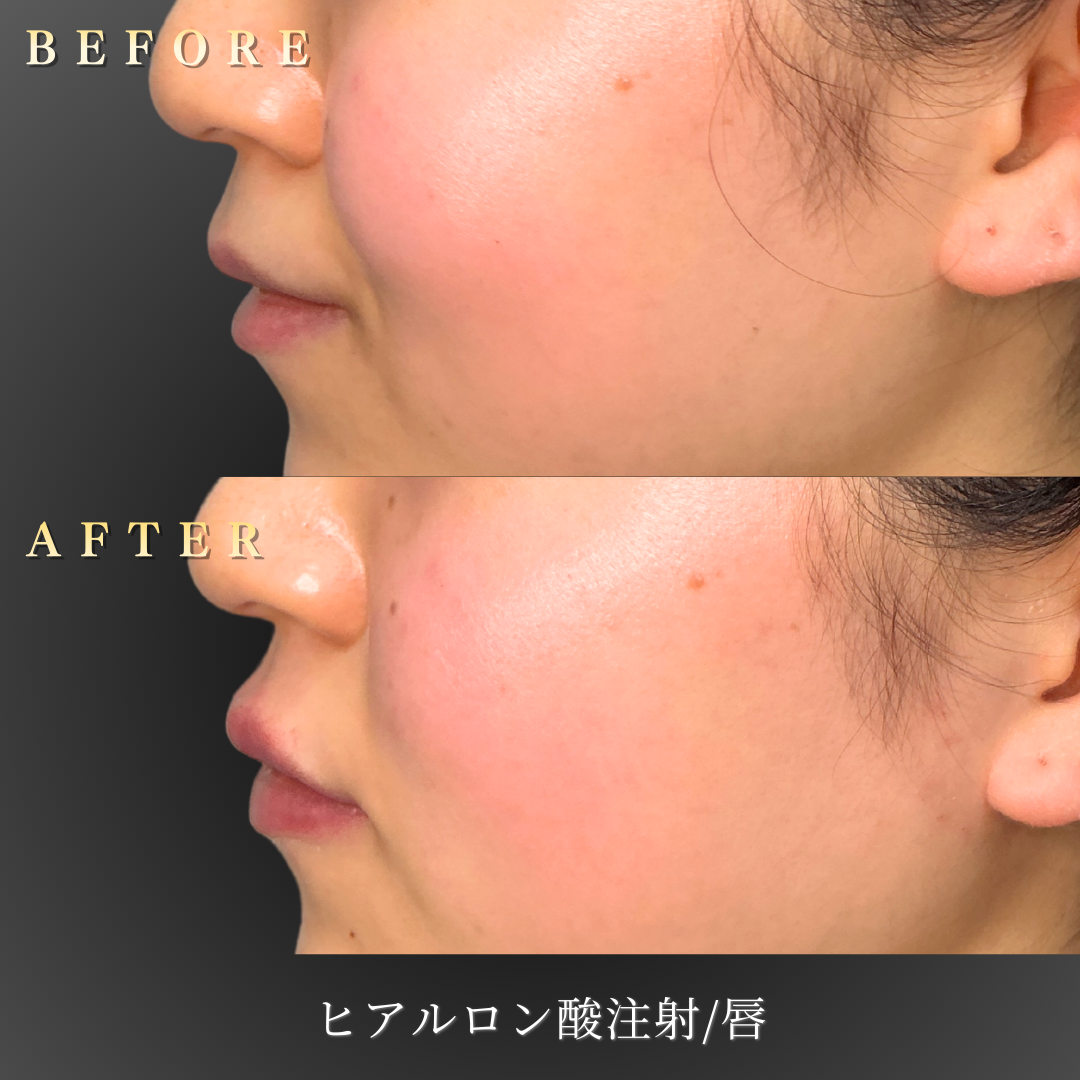 ナチュラルメイクに映える唇を希望する20代女性の施術前写真